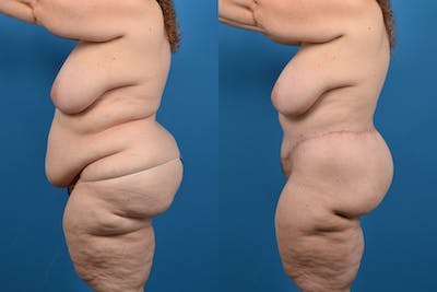 Post-Bariatric Surgery Before & After Gallery - Patient 14779239 - Image 2