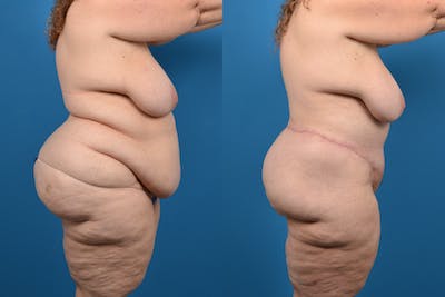 Thigh Lift Before & After Gallery - Patient 14779244 - Image 2