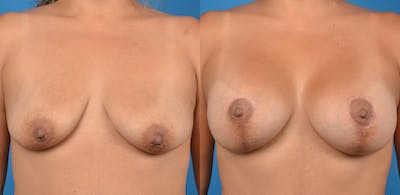 Breast Augmentation Before & After Gallery - Patient 14779160 - Image 1
