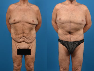 Abdominoplasty Before & After Gallery - Patient 14779210 - Image 1