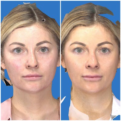 Aesthetic Facial Balancing Before & After Gallery - Patient 14779269 - Image 1
