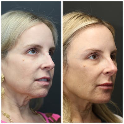Aesthetic Facial Balancing Before & After Gallery - Patient 14779353 - Image 1