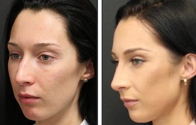 Aesthetic Facial Balancing Before & After Gallery - Patient 11681593 - Image 2